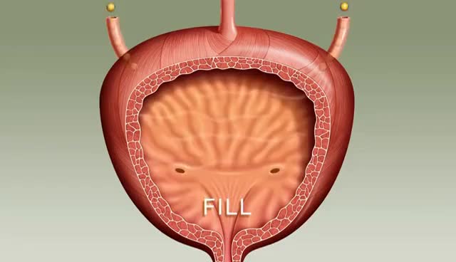 Urine incontinence in women