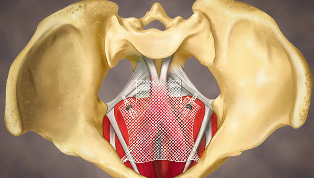 Pelvic floor repair